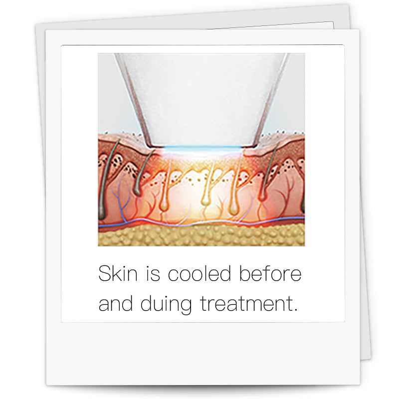 Laseway 808 LASER HAIR REMOVAL ALL SKIN TYPES
