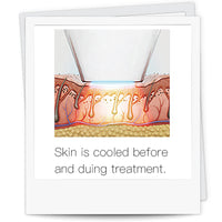 Laseway 808 LASER HAIR REMOVAL ALL SKIN TYPES