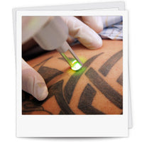 Detattoo Pro Tattoo removal Machine
