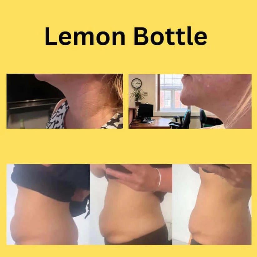 Lemon Bottle 5x10ml Vials for metabolic activation, fat breakdown, and inflammation relief in beauty aesthetics.